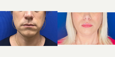 Patient treated with Adam's Apple Reduction - Thyroid Cartilage Shave - 35 to 44 year-old female patient is 2 years post-op from Facial Feminization surgery. Her procedures included: Septorhinoplasty Revision (open) with Cartilage Grafts and Weirs, Thyroid Cartilage Shave and Voice Feminization, Modified Coronal Forehead Lift, Orbital Bony Contouring, Cheek Implants (small) and Subnasal Lip Lift with Fat Augmentation to Lips.