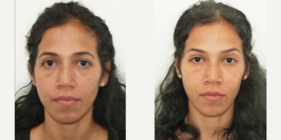 35-44 year old woman treated with Microneedling - 35-44 year old woman treated with Microneedling
