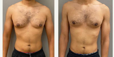 18-24 year old man treated with Gynecomastia Surgery - 24 yo male s/p gynecomastia liposuction with excision performed under local anesthesia with sedation in our on site AAAA certified operating suite.