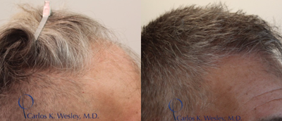 45-54 year old man treated with FUE Hair Transplant - Patient treated with Follicular Unit Extraction (FUE)1 year post op. The hair follicles were incubated in autologous (his own) platelet rich plasma (PRP) throughout the duration of the procedure. This, combined with an ATP-containing storage solution has been shown to enhance survival of transplanted hairs.