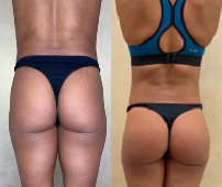 Woman treated with Butt Implants - Woman treated with Butt Implants