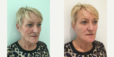 45-54 year old woman treated with Ellanse - Instant refresh and softening of wrinkles. Full new collagen stimulation will take about 8 weeks to set in, at which time the skin texture will be firmer and youthful.