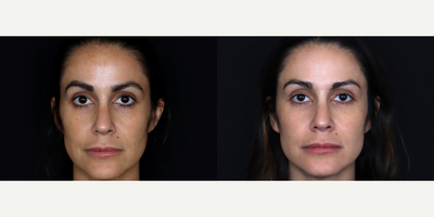 37 year old woman treated with IPL - 37 year old woman treated with IPL to full face. Photos depict before and 1 week after treatment.