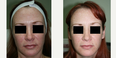 45-54 year old woman treated with Vampire Facial - before vampire facial & 1 day after 3 treatments