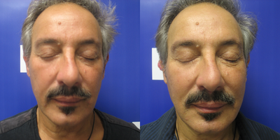 55-64 year old man treated with Vampire Facelift - Versa filler mixed with PRP FOR VOLUME AND COLOR.