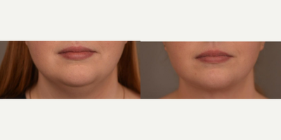Woman treated with Chin Liposuction - Woman treated with Chin/Neck Liposuction. Pre-op, patient had concerns regarding her neck and wanted to get rid of her double chin.