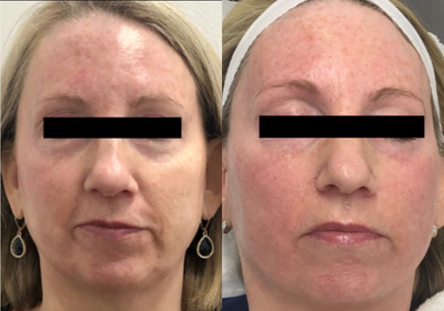55-64 year old woman treated with TempSure Envi - Treated with TempSure Envi for the full face, followed by an Image Skincare Lightening Lift with Mineral SPF 30