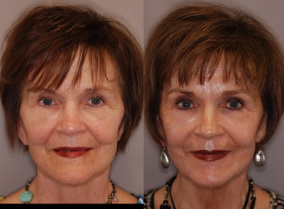 TCA Peel - 
	TCA Peel Before and After
