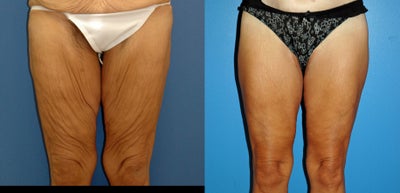 medial thigh lift in bariatric patient - 
	longitudinal medial thigh lift in bariatric patient
