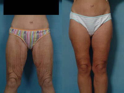 Age: 36, Height: 52, Weight: 132lbs. - 
	Massive Weight Loss.
