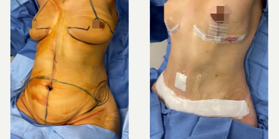 Woman treated with Mommy Makeover - This is for you if... after pregnancy, you've noticed changes in your breasts, stomach, arms, legs, and backside. These changes vary for each woman, but common side effects of pregnancy include sagging skin, loose muscles, minor pockets of fat, or folds and wrinkles. Your breasts may appear deflated or sag and you may see a shift in size or shape. For many moms, a Mommy Makeover could be an answer to these changes and lasting effects on their figure, which affects their confidence when they look in the mirror.