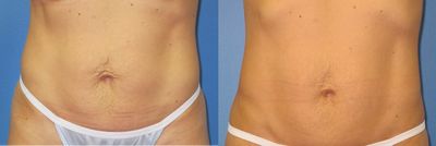 Exilis for skin tightening abdomen - 
	Exilis in a 34 year old woman for skin tightening of abdomen. 4 treatments one week apart. Photos after 3 months.
