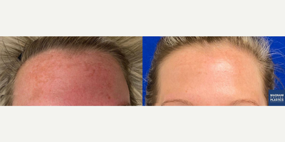 Woman treated with IPL - After 3 IPL sessions to address sun damage and even out this lovely patients skin tone.