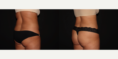 25-34 year old woman treated with Laser Liposuction, Renuvion, Skin Tightening - Liposuction and Renuvion to patients abdomen and flanks.