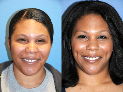 Cheek plastic surgery - Before and After Cheek Dimple Creation