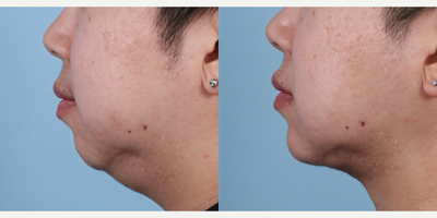 Man treated with Chin Liposuction, Renuvion, Chin Augmentation - Submental Liposuction Plus Renuvion Skin Tightening and Chin Augmentation One month Post Op