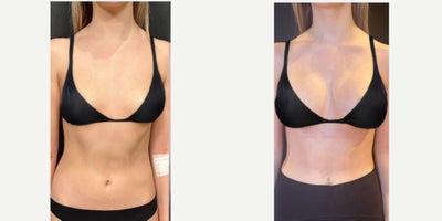 25-34 year old woman treated with Breast Implants, Breast Augmentation - Breast augmentation performed to enhance volume and improve proportion. Implants were placed to achieve a fuller yet natural contour.