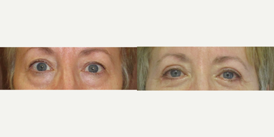 65 year old woman treated with upper eyelift - TBT-lift of the upper eyelids