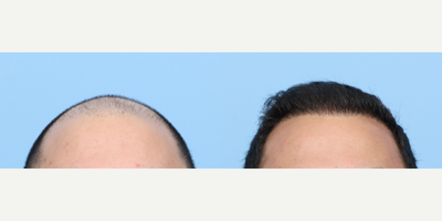 25-34 year old man treated with FUE Hair Transplant, Hair Transplant, Hair Loss Treatment, PRP for Hair Loss - This 26-year-old patient wanted to restore the hair he lost and was looking for a permanent solution. For the results he wanted, Dr. Wise performed both an FUE hair transplant and one session of PRP therapy. During the procedure, 4,015 grafts were placed on the scalp in zones 1 through 4. He will continue to see growth up to 1 year, but is already seeing great results at 6 months post-op.