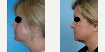 Woman treated with PrecisionTx - Woman treated with PrecisionTx