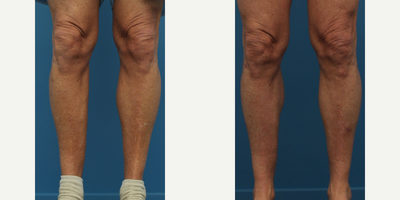 Man treated with Calf Implant - Man treated with Calf Implant