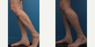 Man treated with Calf Implant - Man treated with Calf Implant