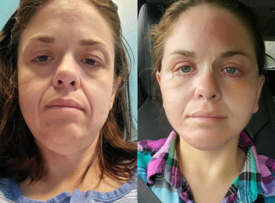 Deep Plane Lower Face and Neck Lift - Lower facelift with neck lift performed under local anesthesia in the office setting. Selfie taken at 3 days post-op.