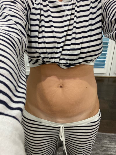 First post-Op check in : Lipo 360/mini tuck/bbl - Review - RealSelf