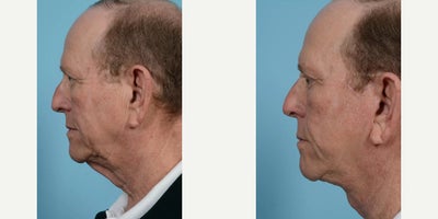 68 year old man treated with Neck Lift, Eyelid Surgery, Brow Lift, Deep Plane Facelift - 68 year old man treated with Neck Lift, Eyelid Surgery, Brow Lift, Deep Plane Facelift