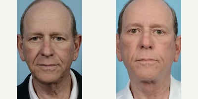 68 year old man treated with Neck Lift, Eyelid Surgery, Brow Lift, Deep Plane Facelift - 68 year old man treated with Neck Lift, Eyelid Surgery, Brow Lift, Deep Plane Facelift