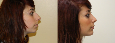 Rhinoplasty - 
	Rhinoplasty and Chin Implant

