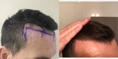 35-44 year old man treated with Hair Transplant - Retoration of The hairline / FUE Hair Transplant Method.2000 grafts implanted to reduce the hairline with maximum density possible.