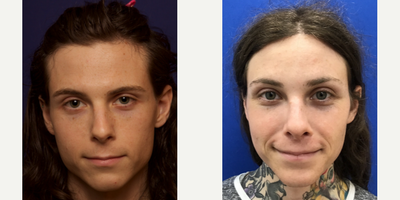 Transgender woman treated with Transgender Facial Feminization Surgery - Transgender woman treated with Transgender Facial Feminization Surgery. She had Hairline Forehead Lift, Hairline Lowering, Orbital Bony Contouring, Septorhinoplasty with cartilage grafts, Voice Feminization, Thyroid Cartilage Shave, Lip Lift, 1cc Juvederm Voluma to the medical cheeks, and 1cc Juvederm to the nasolabial and upper lip.