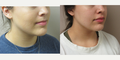 Juvederm filler in lips - Patient is 19 years old and wanted to have fuller looking lips. One syringe of Juvederm was injected in both her upper and lower lips giving her a beautiful result.