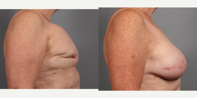 65-74 year old woman treated with Breast Reconstruction Revision - 65-74 year old woman with animation deformity treated with Breast Reconstruction Revision
