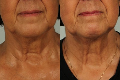 64 year old woman treated with Infini RF - Treated with Infini to full neck