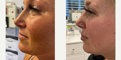 25-34 year old woman treated with Obagi Nu-Derm - She's thrilled with brighter skin after years of discoloration, thanks to the complete Obagi Nu-Derm System with added Obagi Tretinoin .05% and Obagi Hydrate Luxe to moisturize dryness.