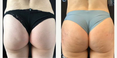 Woman treated with Nonsurgical Butt Lift - Sculptra Butt Lift Before & after
