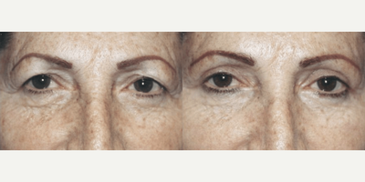 Woman treated with Eyelid Surgery - Woman treated with Eyelid Surgery