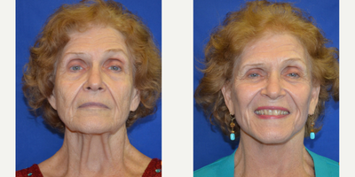 55-64 year old woman treated with Skin Tightening - Skin Tightening Before And After