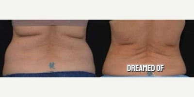 Woman treated with Semaglutide - Woman treated with Semaglutide