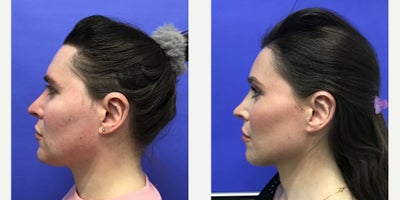 25-34 year old transgender woman treated with Forehead Reduction, Brow Lift, Septoplasty, Lip Lift, Lip Surgery, Adam's Apple Re - 25 to 34 year-old female patient is 1 year 1 month post-op from Facial Feminization surgery. Her procedures included: Forehead Lift, Hairline Lowering, Orbital Bony Contouring, Septorhinoplasty Revision (closed) with Cartilage Grafts, Chin Reduction and Contour, Intranasal Lip Lift, Thyroid Cartilage Shave Revision and Voice Feminization, Soft Tissue to Nasolabial Folds, 500 Micrografts to Hairline Recessions, 2 cc Voluma to Medial Cheeks, and 1 cc Juvederm to Lip Vermillion Bilaterally. Patient is 7 months post-op from 300 additional Micrografts to Hairline Recessions.