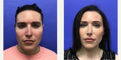 25-34 year old transgender woman treated with Forehead Reduction, Brow Lift, Septoplasty, Lip Lift, Lip Surgery, Adam's Apple Re - 25 to 34 year-old female patient is 1 year 1 month post-op from Facial Feminization surgery. Her procedures included: Forehead Lift, Hairline Lowering, Orbital Bony Contouring, Septorhinoplasty Revision (closed) with Cartilage Grafts, Chin Reduction and Contour, Intranasal Lip Lift, Thyroid Cartilage Shave Revision and Voice Feminization, Soft Tissue to Nasolabial Folds, 500 Micrografts to Hairline Recessions, 2 cc Voluma to Medial Cheeks, and 1 cc Juvederm to Lip Vermillion Bilaterally. Patient is 7 months post-op from 300 additional Micrografts to Hairline Recessions.