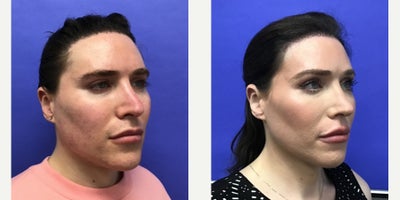 25-34 year old transgender woman treated with Forehead Reduction, Brow Lift, Septoplasty, Lip Lift, Lip Surgery, Adam's Apple Re - 25 to 34 year-old female patient is 1 year 1 month post-op from Facial Feminization surgery. Her procedures included: Forehead Lift, Hairline Lowering, Orbital Bony Contouring, Septorhinoplasty Revision (closed) with Cartilage Grafts, Chin Reduction and Contour, Intranasal Lip Lift, Thyroid Cartilage Shave Revision and Voice Feminization, Soft Tissue to Nasolabial Folds, 500 Micrografts to Hairline Recessions, 2 cc Voluma to Medial Cheeks, and 1 cc Juvederm to Lip Vermillion Bilaterally. Patient is 7 months post-op from 300 additional Micrografts to Hairline Recessions.