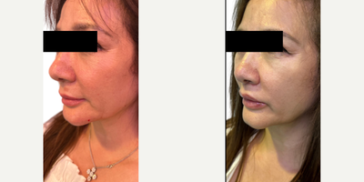 Woman treated with Dermal Fillers, Lip Fillers, Chin Filler - Woman treated with Dermal Fillers, Lip Fillers