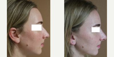 18-24 year old woman treated with Rhinoplasty - This wonderful patient desired correction of her dorsal hump and over-projected nose without changing her entire look. Here she is 2 months status post open rhinoplasty.