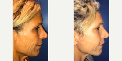 Woman treated with Facial Fat Transfer - Woman treated with Facial Fat Transfer and Facelift for added volume and to provide a soft and natural looking result, shown 5 weeks post op.