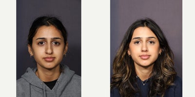 18-24 year old woman treated with Septoplasty - The 19-year-old patient pictured above chose to undergo a septorhinoplasty in San Diego to better balance her petite facial features. The decision was not made lightly, but with the intent to enhance her natural beauty without dramatically altering her appearance. Her preference was a gently sloped dorsal profile, a goal she entrusted with skilled surgeon, Dr. Riedler.The technique utilized was septorhinoplasty, a procedure that shows a profound dedication from both patient and surgeon. The patient showed immense trust in Dr. Riedler's expertise, while the double board-certified facial plastic and reconstructive surgeon exhibited her exceptional ability to understand a patient's goals and make them a reality. The procedure was performed at the La Jolla Cosmetic Surgery Centre, located at 9850 Genesee Ave Suite 130, La Jolla, California 92037 US.Thirteen months post-operation, the results were apparent. What the above images highlight, more than the cosmetic change, is the patient's sheer joy in her outcome. With a natural-looking nose that perfectly complements her petite features, she could not be happier with her decision to undergo a septorhinoplasty in San Diego with Dr. Riedler.