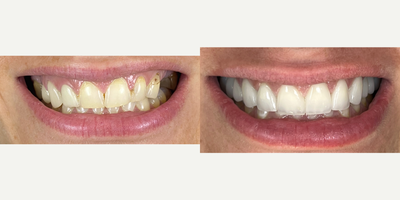 35-44 year old woman treated with Full Mouth Reconstruction, Dental Crown, Dental Implants, Porcelain Veneers - Female patient wanted to transform her smile and restore excessive dental wear due to bruxism and clenching, patient wanted to have a really bright smile and also restore missing teeth that were removed/lost in the past. Treatment was done in a period of 4 months due to implant placement. Dental implants requiere at least 3 months of healing time in order to fabricate final restoration. The whole process was previously designed by utilizing a digital smile design software that allows to generate different prototypes of her new smile ahead of time, the patient has a the option to choose from 3 or 4 different smile designs, and this information is transferred to our dental ceramist, so the results can be a 100% predictable. Post op photographs were taken 2 weeks after final delivery of all restorations, patient is coming back next year to complete her lower arch. She is very happy with the results and her new smile restore not only her function and aesthetics, but also her confidence.