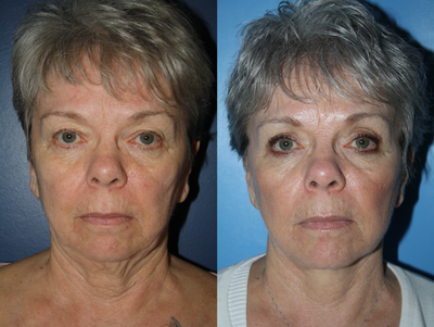 Upper and lower blepharoplasties and facelift. - 
	This pleasant patient underwent upper and lower blepharoplasties (eye lift) as well as facelift. Note her refreshed yet completely natural appearance.
